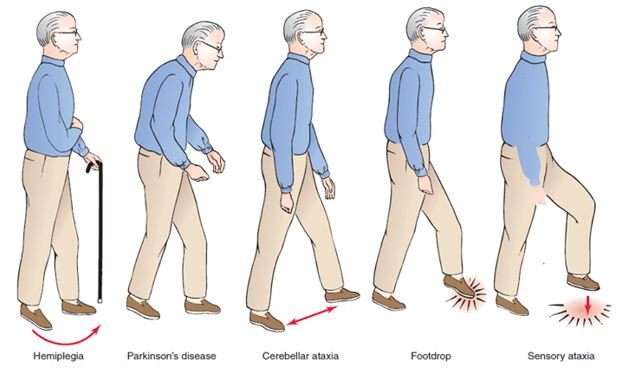 gait analysis